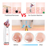 Seraxis Electric Blackhead Remover